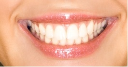 bonding and white fillings 1.jpg